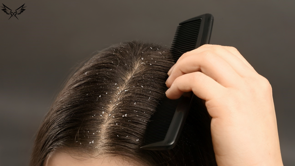 Dandruff Comb